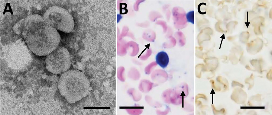 Morphologic features of Candidatus Mycoplasma haemohominis isolated from a serum sample of a 42-year-old man, Japan. A) Spheres are bacterial particles with a diameter of 300–600 nm. Negative stained; scale bar indicates 200 nm. B) Bacteria on the surface of erythrocytes (arrows in the left panel). In situ hybridization showing bacteria on the surface of erythrocytes (arrows in the right panel). Giemsa stained; scale bar indicates 10 μm.