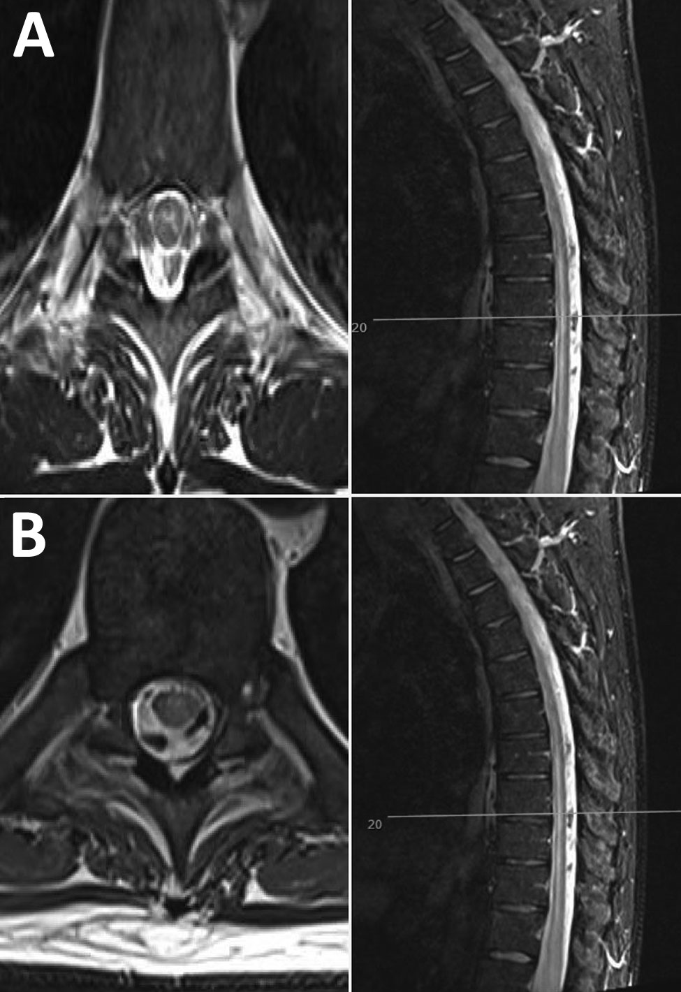 Neurologic manifestations of tick-borne encephalitis in a 38-year-old man from the United Kingdom after travel to Lithuania. A) Magnetic resonance imaging of the brain and spinal cord at onset of neurologic signs, showing possible longitudinal extensive transverse myelitis in the cervical and thoracic cord, with involvement of the central gray matter. B) One month later, increased T2 signal and mild swelling of the central gray matter of the cervical cord have both regressed, with some residual 