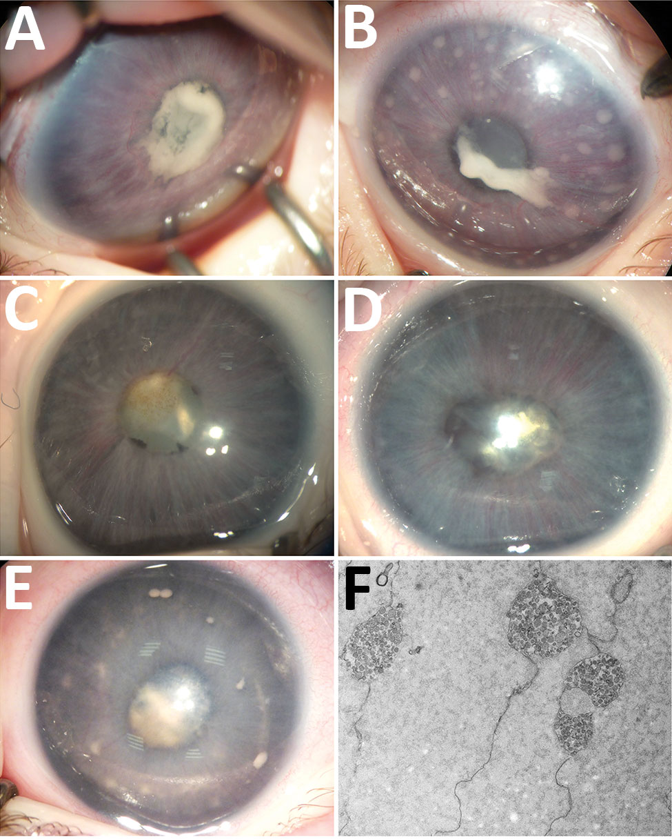 Ocular anterior segment in 3 newborn infants with bilateral total cataract and anterior uveitis related to endogenous Spiroplasma ixodetis infection. A, B) Case-patient 1. Right (A) and left (B) eyes of a 4-week-old girl showing total cataract, posterior synechiae due to a cyclitic fibrinic membrane, and large keratic precipitates more visible in the left eye. The immature iris vasculature is dilated in the context of anterior segment inflammation. C, D) Case-patient 2. Right (C) and left (D) ey