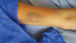 Thumbnail of Ecchymosis on the forearm of a man diagnosed with Crimean-Congo hemorrhagic fever in Mauritania, 2019.