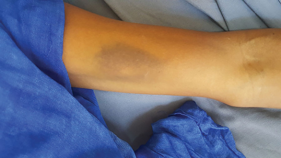 Ecchymosis on the forearm of a man diagnosed with Crimean-Congo hemorrhagic fever in Mauritania, 2019.