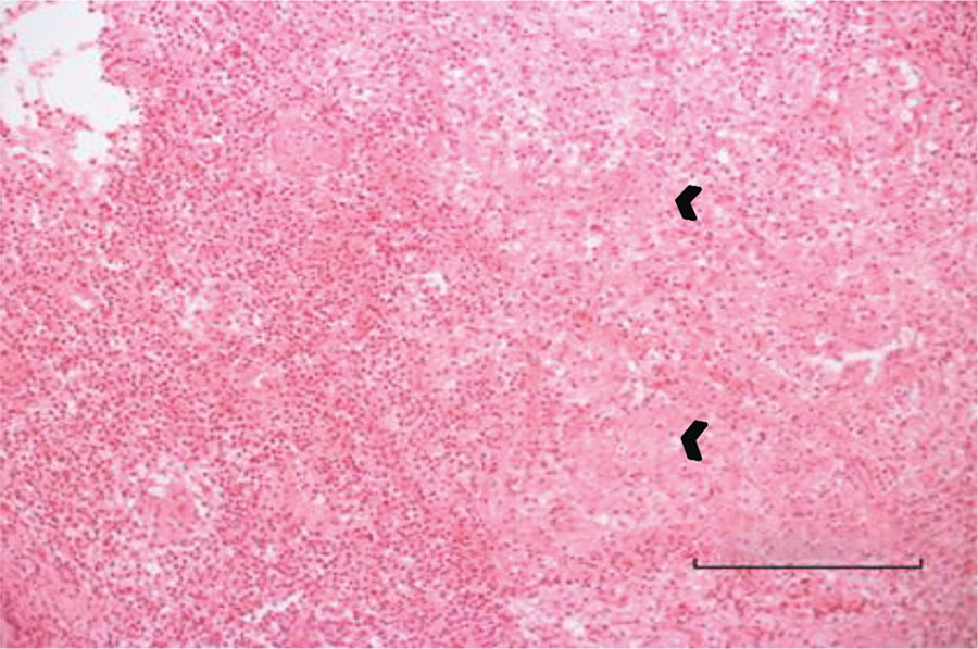 Bone biopsy specimen for a 3-year-old boy (case 1) with Q fever osteoarticular infection, Israel. Hematoxylin and eosin stain shows an acute inflammatory process with neutrophil and lymphocyte predominance. Small arrows indicate giant cells and epithelioid granuloma without necrosis. Bar indicates the diameter of a giant granuloma. 