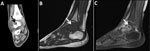 Thumbnail of Imaging of the left ankle for a 3-year-old boy (case 3) with Q fever osteoarticular infection, Israel. A) Computed tomography imaging, coronal view, shows a lytic lesion in the talus (black arrow). B, C) Magnetic resonance imaging sagittal T1 (B) and sagittal T1 fat saturation + contrast (C) demonstrate a lesion in the posterior aspect of the talus (white arrows), determined to be an intramedullary abscess (Brodie’s abscess) surrounded by edema.