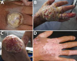 Thumbnail of Clinical progression of vaccinia virus infection in a patient with HIV/AIDS, Columbia. A) On December 9, 2014, the patient was referred to the Hospital Universitario Mayor Méderi because of a suppurative ulcer with sharply raised, defined edges on his right hand. B, C) In March 2015, lesions increased in size and disseminated over his face and extremities. D) In July 2015, most lesions completely healed, with mild scarring and depigmentation.
