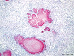 Caseonecrotic lung lesions in free-ranging pronghorn found to be strongly immunopositive for Mycoplasma bovis antigen by immunohistochemical analysis, Wyoming, USA, February–April 2019. Positive staining indicated by fast red coloring has strong intensity and specificity for lesions centered on bronchioles. Scale bar indicates 1 mm.