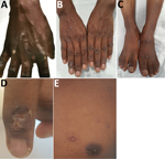 Thumbnail of Dermatologic features of monkeypox in a 38-year-old man, Singapore, 2019. A) Pustular lesions on the hand at the start of hospitalization. B, C) Resolving lesions with shedding of scabs of the hands (B) and feet (C) toward end of hospitalization (day 17). D, E) Crusting of right fourth finger lesion (D) and lesions at varying stages (vesicles and scabbing) on the left chest (E) on day 15 of hospitalization.