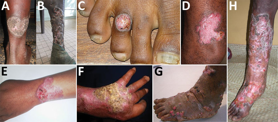 Clinical forms of chromoblastomycosis caused by Fonsecaea sp., Madagascar. A) Plaque; B) mixed: tumorous and cicatricial; C) nodular; D) raised plaque; E) plaque; F) cicatricial; G) tumorous caused by Cladophialophora carrionii; H) mixed: cicatricial and modified by previous therapy.
