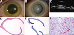 Thumbnail of Cataract surgery in an Ebola virus disease survivor with prior ocular viral persistence. A) Slit lamp image shows green iris hue when patient developed panuveitis with heterochromia. B) The greenish coloration resolved but a dense intumescent cataract developed as shown in the second slit lamp image. C) Ultrasound biomicroscopic examination demonstrates the bulging of the anterior lens capsule (yellow arrow) and shallowing of the anterior chamber (*), which presents an increased ris