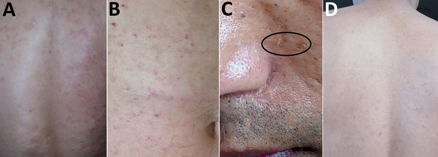 Lesions on the skin of a patient infected with Oxyspirura larvae, Vietnam. A, B) Lesions on the back and abdomen. C) Lesions on the face, with visible larvae. D) Lesions on the patient’s back 2 months after treatment.