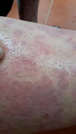 Thumbnail of Oxyspirura larvae emerging from skin of the neighbor of a case-patient with severe pruritic skin lesions, Vietnam. Video provided by the case-patient.
