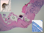 Thumbnail of Kidney core biopsy of a child with disseminated Echinococcus multilocularis infection without liver involvement, Canada, 2018. Shown are folded laminated membrane (short black arrows) encircling variable-sized cystic structures (black circles) containing calcified and necrotic debris and dense periparasitic fibrosis (long black arrows), in a background of chronic inflammation and fibrosis. No residual normal kidney parenchyma was seen (hematoxylin and eosin stain, original magnifica