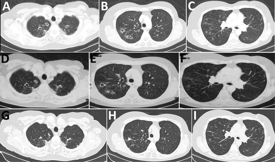 Chest computed tomography scan 1 month after antituberculosis treatment initiation (A–C), at the time of Mycolicibacter kumamotonensis identification (D–F), and 1 year after treatment initiation for M. kumamotonensis (G–I). Resolution of cavities and scar formation (A to D to G), resolution of pulmonary infiltrations (B to E to H), and hardening of the nodular appearances (C to F to I) are shown.