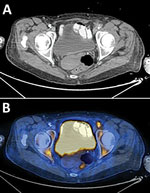 Imaging of an immunocompromised patient who had endovascular infection with Kingella kingae complicated by septic arthritis, Israel. A) Computed tomography scan shows a luminal stenosis in the transition zone of the left external iliac artery and common femoral artery along with surrounding turbid fat. B) Fluorodeoxyglucose positron emission tomography–computed tomography scan showing high fluorodeoxyglucose uptake in the plaque causing the stenosis.