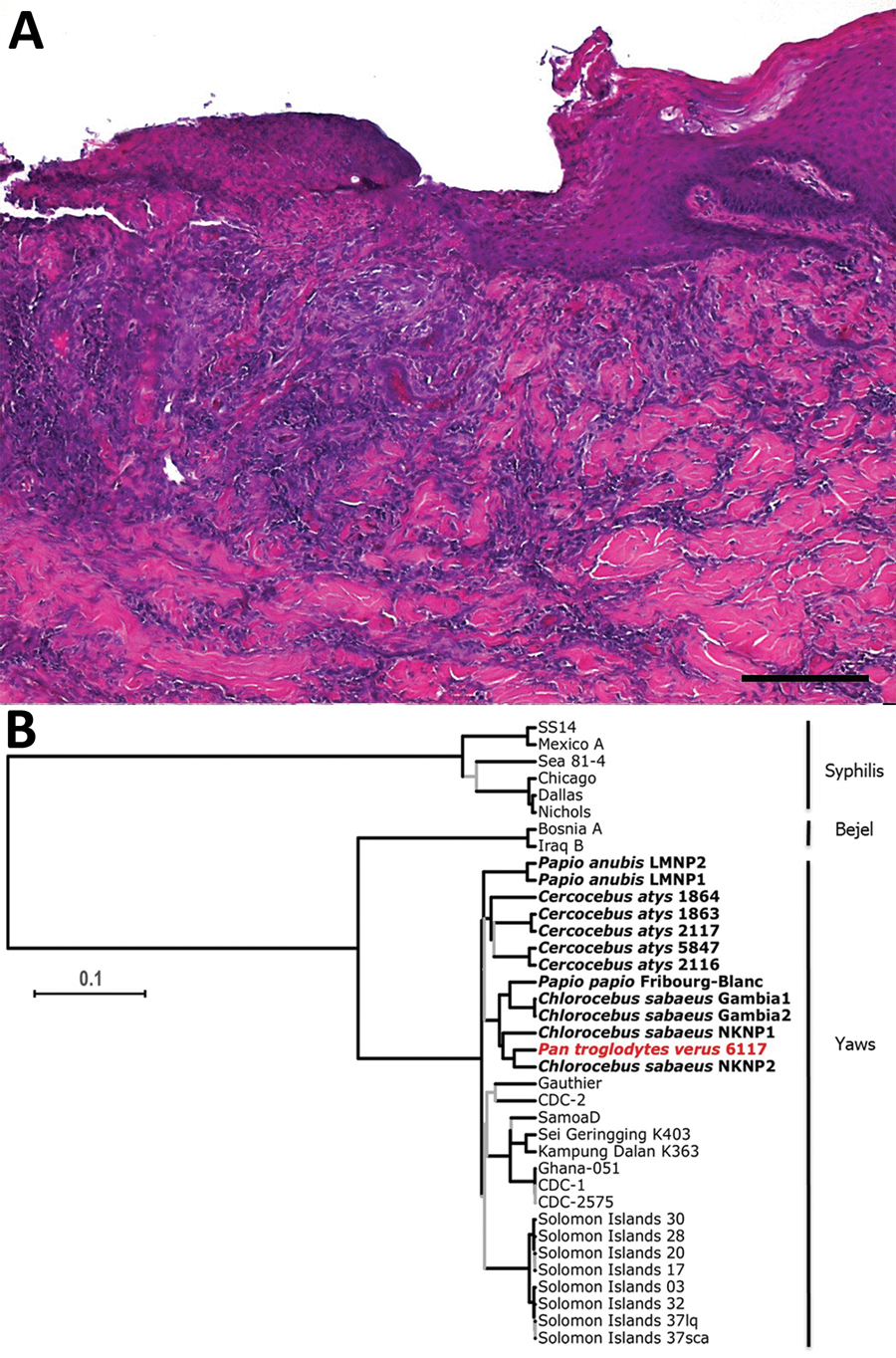 Histopathologic and phylogenetic analysis of yaws-like lesions and Treponema pallidum subspecies pertenue in a wild chimpanzee, Guinea. A) Histopathologic evidence suggestive of a treponemal infection. Shown here is superficial ulcerative pyogranulomatous dermatitis including formation of a mixed inflammatory cell infiltration, predominantly neutrophil granulocytes. Deeper dermal layers show the formation of a perivascular lymphocytic inflammatory cell infiltrate, focal folliculitis, and perifol