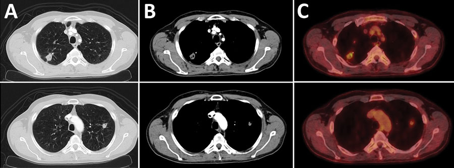 High-resolution computed tomography and 18F-fluorodeoxyglucose positron emission tomography scans of the chest showing pulmonary lesions caused by Mycobacterium hassiacum in a 62-year-old man, Austria. A and B) Computed tomography scans of the chest showing a subpleural thick-walled cavitary lesion in the posterior segment of the right upper lung lobe with associated pleural thickening and a smaller adjacent partly calcified solitary nodule. Another solid nodule of 13 mm diameter was found in the left upper lung lobe. C) Positron emission tomography scan showing a tracer uptake in both lesions with a standardized uptake values of 5 (top image) and 1.9 (bottom image). 