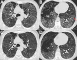 Chest computed tomography (CT) images at the level of the upper third and the lower third of the lung in a patient with pulmonary histoplasmosis, Switzerland. A, B) Initial CT shows diffuse reticulonodular pattern with ground glass opacifications, predominantly located in the upper two thirds of the lungs, and several areas with reverse halo signs (red arrows). C, D) Follow-up CT scan exhibited reduced ground-glass opacities and a regression of the micronodules. The reversed halos showed complete regression. CT, computed tomography. 