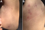 Thumbnail of Roundish, targetoid patches, with peripheral erythematous halo and central lightening located on left abdomen (A) and on the back (B) of a 48-year-old woman with trombiculosis, Italy, April 2019.