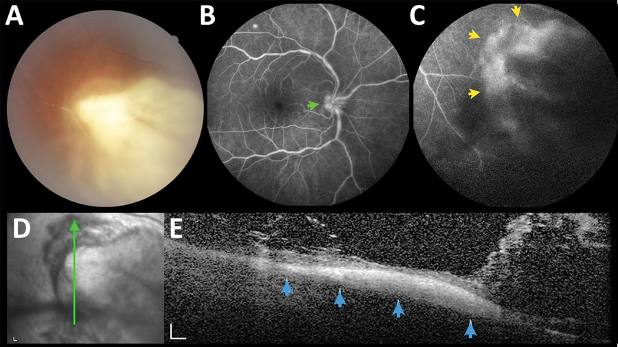 A large necrotizing retinochoroiditis lesion in the right eye, detected in baseline examination (VA 0.5) of a 42-year-old man in a presumed waterborne toxoplasmosis outbreak, Brazil. A) Fundus photograph showing dense focal retinal whitening with indistinct borders, associated with overlying vitreous haze. B) Fundus fluorescein angiography; green arrow indicates hyperfluorescence of optic disc. C) Fundus fluorescein angiography; yellow arrows indicate hyperfluorescence indicating late leakage at the margins of the retinochoroiditis lesion. D) Red-free reflectance showing changes at the level of the active lesion. Green line indicates site of optical coherence tomography scan. E) Spectral-domain optical coherence tomography; blue arrows indicate focal full-thickness hyper-reflectivity and disorganization of retinal layers, surrounding retinal thickening, and numerous overlying hyper-reflective dots and bands, indicating exuberant inflammatory vitreous exudation. Scale bars indicate 200 µm. VA, visual acuity.