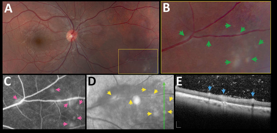 Asymptomatic retinochoroiditis in the right eye, detected in baseline examination (VA 0.0) of a 27-year-old man in a presumed waterborne toxoplasmosis outbreak, Brazil. A) Fundus photograph showing minimal vitreous haze; box indicates enlarged area on B); green arrows indicate multiple subtle and confluent gray-whitish punctate retinal infiltrates. C) Fundus fluorescein angiography. Pink arrows indicate leakage at the site of some of the punctate lesions. D) Fundus fluorescein angiography with red-free reflectance. Green line indicates site of optical coherence tomography scan. Yellow arrows indicate changes in the area of active focuses. E) Spectral-domain optical coherence tomography showing retinal thickening, and numerous overlying hyper-reflective dots. Blue arrows indicate multifocal hyper-reflectivity at the inner retinal layers. Scale bars indicate 200 µm. VA, visual acuity.