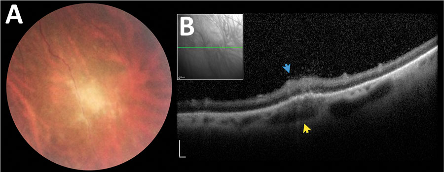 Asymptomatic late retinochoroiditis in right eye detected in follow-up examination at month 37 (visual acuity 0.0) in 28-year-old woman from a presumed waterborne toxoplasmosis outbreak, Brazil. A) Fundus photograph showing focal retinal whitening with indistinct borders. B) Spectral-domain optical coherence tomography showing hyper-reflectivity, disorganization, and thickening of inner retinal layers (blue arrow), and numerous overlying hyper-reflective dots at the overlying vitreous and fusiform thickening of underlying choroid (yellow arrows). Scale bars indicate 200 µm.