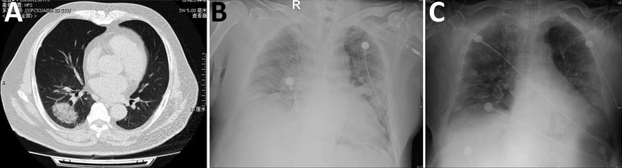 Radiographs of patient co-infected with severe acute respiratory syndrome coronavirus 2 and influenza A virus, China, 2020. A) Chest computed tomography demonstrating a mass, ground-glass consolidation in the right inferior lobe. B) Chest radiograph showing bilateral diffuse exudative shadows, indicating acute respiratory distress syndrome. C) Chest radiograph showing improved lung fields after 4 days in the intensive care unit.