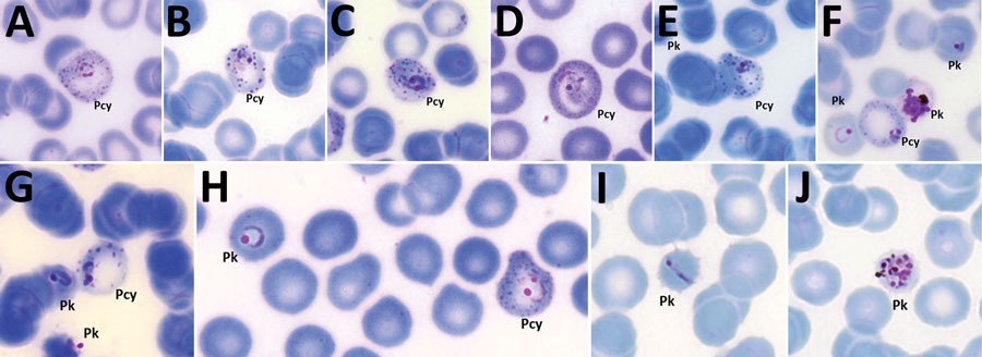 Plasmodium cynomolgi and P. knowlesi parasites in patient K07, admitted to Kapit Hospital with malaria during June 24, 2013–December 31, 2017, Malaysian Borneo. A–G) Early trophozoites of P. cynomolgi in enlarged and, at times, distorted erythrocytes, with Schüffner’s stippling and either single, double, or triple chromatin dots. E–H) P. knowlesi and P. cynomolgi early trophozoites. I) Band form trophozoite of P. knowlesi. J) Schizont of P. knowlesi. Pcy, P. cynomolgi; Pk, P. knowlesi. Original 