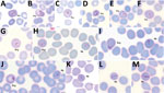 Thumbnail of Plasmodium cynomolgi and P. knowlesi parasites in patient K199, admitted to Kapit Hospital with malaria during June 24, 2013–December 31, 2017, Malaysian Borneo. A–G) Early trophozoites of P. cynomolgi within enlarged and, at times, distorted erythrocytes, with Schüffner’s stippling and single, double, or triple chromatin dots. H–J) Early trophozoites of P. knowlesi and P. cynomolgi. K–M) Band form trophozoites of P. knowlesi. Pcy, P. cynomolgi; Pk, P. knowlesi. Magnification ×100.