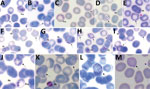 Thumbnail of Plasmodium cynomolgi and P. knowlesi parasites in patient K07, admitted to Kapit Hospital with malaria during June 24, 2013–December 31, 2017, Malaysian Borneo. Arrows indicate Schüffner’s stippling in erythrocytes without parasites. A–C) Early trophozoites of P. cynomolgi; D–I) early trophozoites of P. knowlesi; J) early trophozoites of P. knowlesi and P. cynomolgi; K) gametocyte of P. knowlesi. Pcy, P. cynomolgi; Pk, P. knowlesi. Magnification ×100.