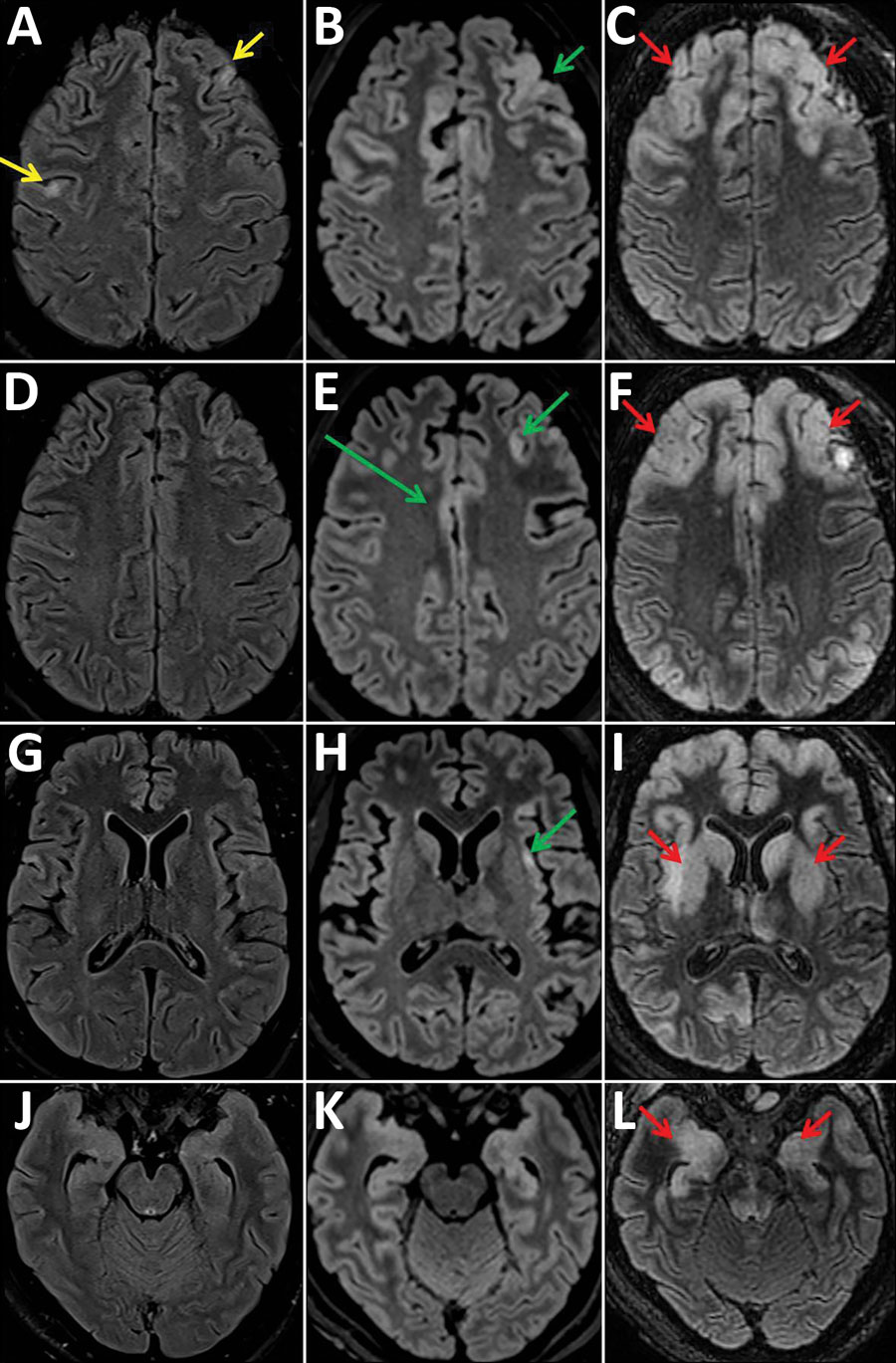 Fluid-attenuated inversion recovery images of magnetic resonance examinations of the brain in a 28-year-old woman from Romania with untreated AIDS and measles inclusion-body encephalitis. Images were taken 1 week (A, D, G, J), 2 weeks (B, E, H, K), and 5 weeks (C, F, I, L) after hospital admission, at the same brain levels. The first examination shows focal cortical hyperintensities (yellow arrows) in the left and right frontal cortex. After 2 weeks, these cortical hyperintensities have widened 