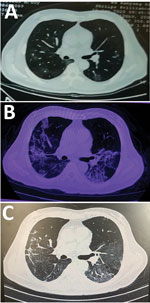 Thumbnail of Computed tomography (CT) scan of the lungs of a 60-year-old man before and after severe acute respiratory syndrome coronavirus 2 (SARS-CoV-2) infection and rhabdomyolysis, Wuhan, China, 2020. A) CT scan before diagnosis of SARS-CoV-2 infection (3 days before hospital admission) revealed the lungs were thickened and scattered with ground-glass shadows. B) CT scan after diagnosis of SARS-CoV-2 infection with rhabdomyolysis (on hospital day 10) indicated that most of both lungs were co
