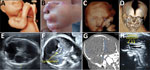Prenatal ultrasound, computed tomography, and postmortem aspect of a fetus with congenital Zika syndrome related to maternal prolonged viremia in patient (case no. 122) in a cohort study of pregnant women admitted to Centre Hospitalier de l’Ouest Guyanais, French Guiana, January 1–July 15, 2016. The mother had symptomatic acute Zika virus infection at 8 weeks’ gestation (and had ongoing viremia until birth of her stillborn child with signs of congenital Zika syndrome. Severe microcephaly, ventriculomegaly, and calcifications were detected by ultrasound at 13 weeks’ gestation. Overall, this fetus had arthrogryposis detected on 3-D ultrasound (A) and postmortem (B); severe bilateral microphthalmia (blue arrows) detected on 3-D ultrasound (C) and fetal computed tomography (D); microcephaly with atrophic cortex detected on ultrasound (E) showing a head circumference of 160 mm at 25 weeks’ gestation (−5 SDs); ventriculomegaly detected on ultrasound (E); brain calcifications (blue arrows) detected on ultrasound (F) and computed tomography (G); pontocerebellar hypoplasia (yellow arrows) detected on ultrasound (F); and corpus callosum dysgenesis (yellow arrows) detected on ultrasound (H).