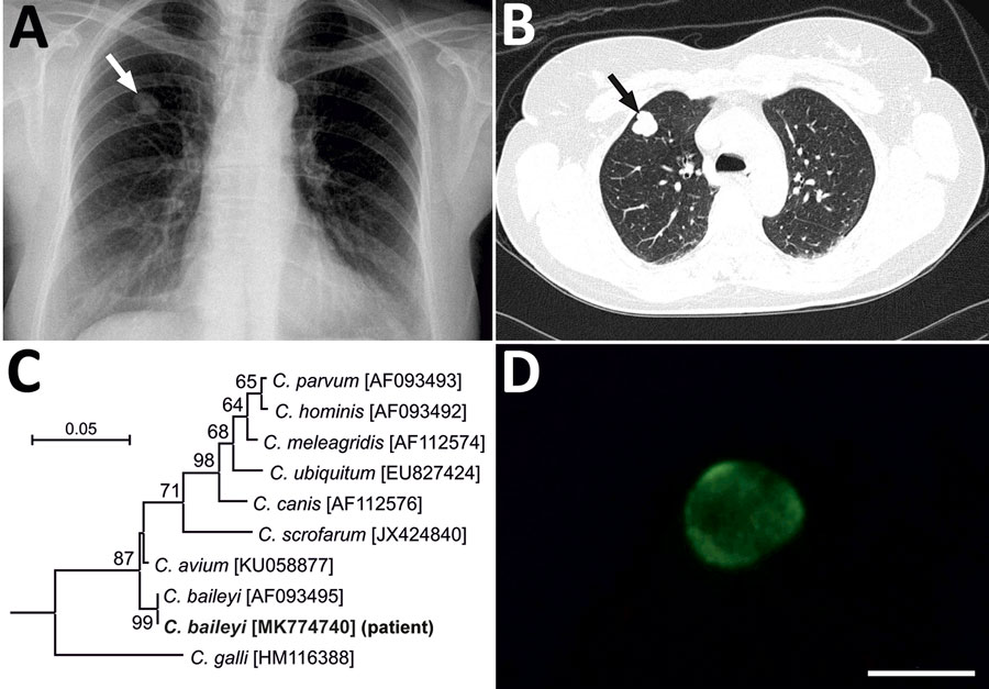 Findings from a 51-year-old immunocompetent woman with a benign neoplasm and Cryptosporidium baileyi pulmonary infection, Poland, 2015. A) Chest radiography in posterior-anterior position. A tumor, 13 × 18 mm with well-defined boundaries, is visible in the third segment of the upper right lung (arrow). B) Patient’s lung tomogram. Tumor is visible in the right lung (arrow). C) Maximum log likelihood tree based on partial sequences of gene coding small subunit rRNA of Cryptosporidium, including se