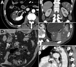 Thumbnail of Abdominal contrast-enhanced computed tomography scans of 3 coronavirus disease patients with abdominal visceral infarction, Italy. A) Patient 1 (axial view) showing intraarterial thrombi in the renal artery (arrow) and kidney and splenic infarctions (asterisk), seen as large wedge-shaped hypodense parenchymal areas. B, C) Patient 2 (B, coronal view; C, axial view) showing kidney and splenic infarctions (asterisks), seen as large wedge-shaped hypodense parenchymal areas. D, E) Patien