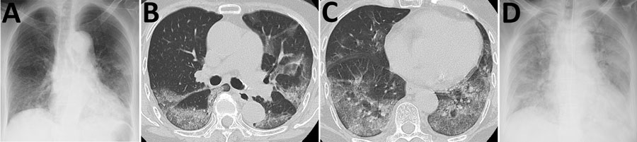 Chest radiograph and computed tomography results from an 84-year-old woman who died from coronavirus disease, Toshima Hospital, Tokyo, Japan, February 2020. A) Chest radiographs taken on admission (illness day 8), showing reticular shadows, mainly in bilateral lower lung fields. B, C) Chest computed tomography scan taken on illness day 8, indicating ground-glass opacities mainly located in posterior segments of the bilateral lower lobes, where the highest numbers of viral RNA copies were found o