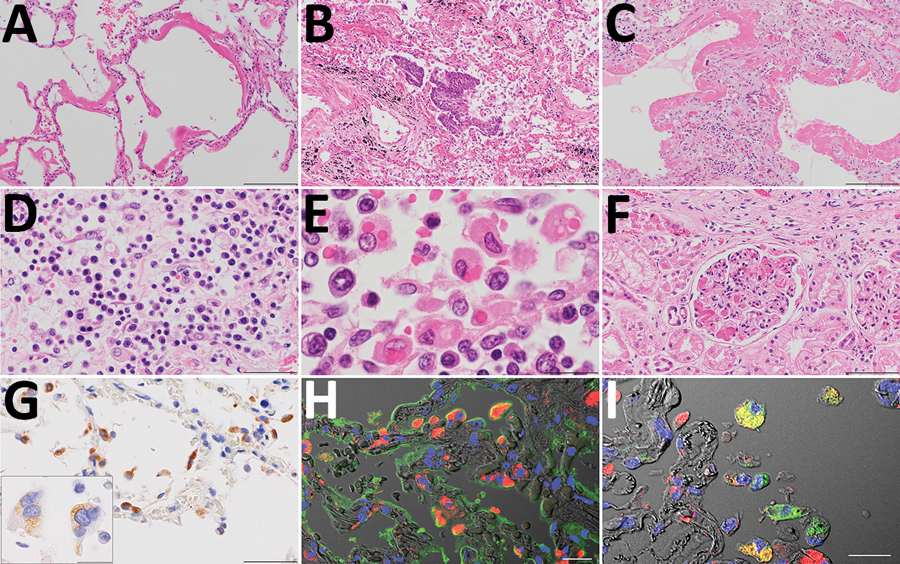 Pathologic findings for the lungs, lymph nodes, and kidneys in an autopsy of an 84-year-old woman who died from coronavirus disease, Toshima Hospital, Tokyo, Japan, February 2020. A) Marked diffuse alveolar damage in exudative phase with prominent hyaline membrane formation in lung tissues. Hematoxylin &amp; eosin (H&amp;E) staining. Scale bar indicates 200 µm. B, C) Desquamation and squamous metaplasia of the epithelium (B) and organized hyaline membranes (C), with septal fibrosis in the organi