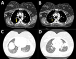 Thumbnail of Thoracic computed tomography angiography of a 36-year-old postpartum woman with coronavirus disease and acute pulmonary embolism, Iran. A, B), Thoracic computed tomography angiography showing filling defect in the right side inter-lobar artery (arrow) and posterior basal segment and left-sided pleural effusion (arrow). C, D) Consolidation and ground-glass opacities affecting the left ligula and posterior recess.