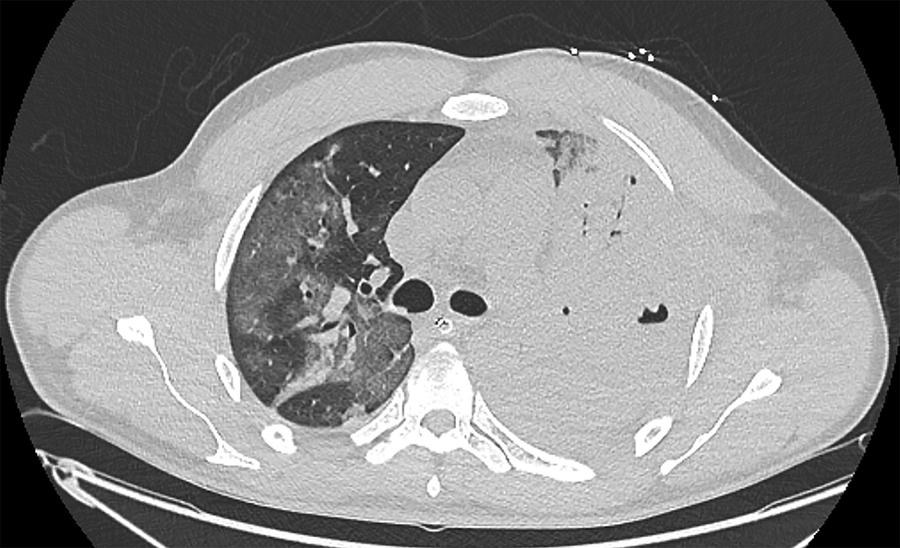 Chest computed tomography of a patient in France with Panton-Valentine leukocidin–secreting Staphylococcus aureus pneumonia complicating coronavirus disease, showing worsening of bilateral parenchymal damage with complete consolidation of the left lung, cavitary lesions suggestive of multiple abscesses, and appearance of areas of ground-glass opacities in the right lung