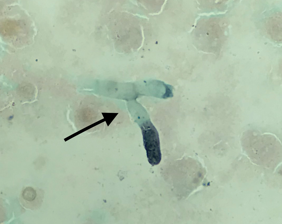 Microscopic image of silver-stained tracheal aspirate from an immunocompetent patient critically ill with coronavirus disease, France. Filaments suggestive of Aspergillus sp. are shown (black arrow). Original magnification ×1,000.