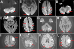 Thumbnail of Cerebral magnetic resonance image (MRI) showing acute ischemic stroke in multiple vascular areas of 2 coronavirus disease patients, France. A–F) Patient 1. Diffusion weighted imaging (DWI) showed hyperintensive lesions of bilateral cerebellar hemispheres (arrows, A), right occipital cortex (arrows, B), bilateral centrum semiovale and bilateral parietal cortex (arrows, C). A part of the lesions are already hyperintensive in FLAIR (fluid-attenuated inversion recovery) sequences (arrow
