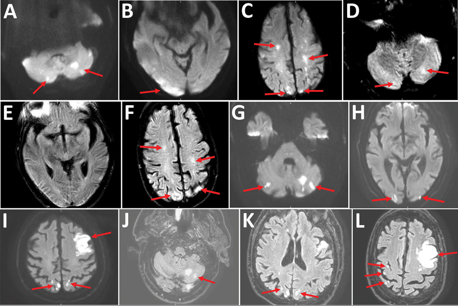 Cerebral magnetic resonance image (MRI) showing acute ischemic stroke in multiple vascular areas of 2 coronavirus disease patients, France. A–F) Patient 1. Diffusion weighted imaging (DWI) showed hyperintensive lesions of bilateral cerebellar hemispheres (arrows, A), right occipital cortex (arrows, B), bilateral centrum semiovale and bilateral parietal cortex (arrows, C). A part of the lesions are already hyperintensive in FLAIR (fluid-attenuated inversion recovery) sequences (arrows, D, F). Nor