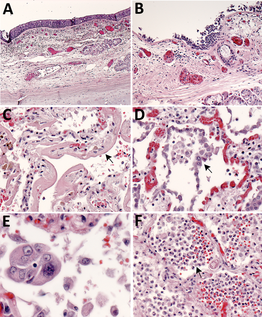 Pulmonary histopathology in fatal coronavirus disease cases caused by severe acute respiratory syndrome coronavirus 2 infection. A) Patient no. 5: tracheitis characterized by moderate mononuclear inflammation within the submucosa (original magnification ×10). B) Patient no. 3: extensive denudation of tracheal epithelium; submucosal congestion, mild edema, and mononuclear inflammation (original magnification ×10). C) Patient no. 4: exudative phase of diffuse alveolar damage characterized by abund