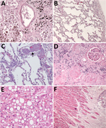 Thumbnail of Histopathologic findings associated with underlying conditions in fatal coronavirus disease. A) Patient no. 2: lung, hemosiderin-laden macrophages (brown pigment, bottom left), and anthracosis (black pigment, top right) in a patient with congestive heart failure (original magnification ×20). B) Patient no. 3: lung, emphysema in a patient with chronic obstructive pulmonary disease (original magnification ×5). C) Patient no. 7: lung, pulmonary microthrombosis (arrow) (original magnifi