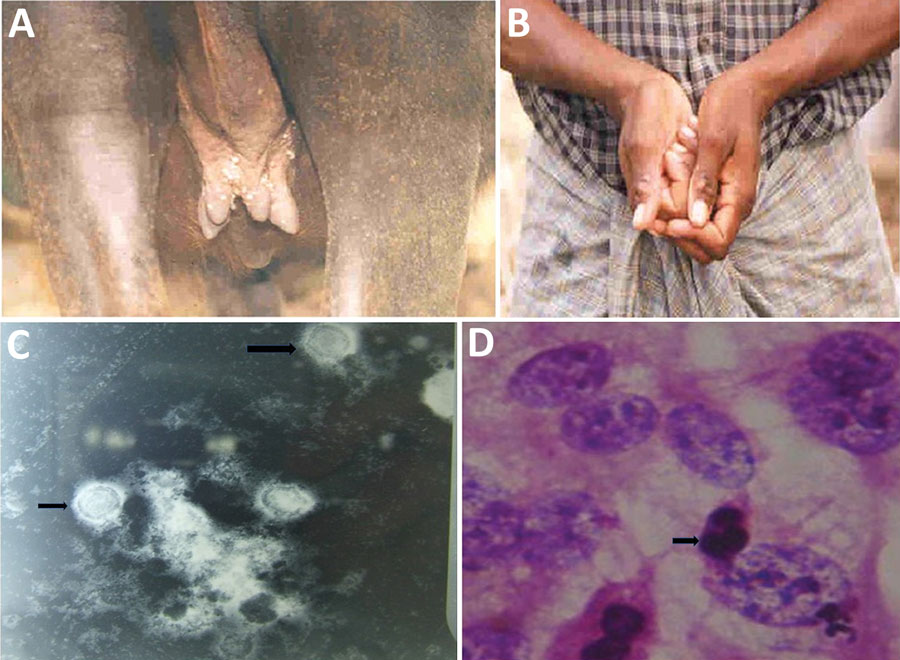 Buffalopox outbreak caused by vaccinia virus, Tamil Nadu, India. A) Buffalopox lesions on the udder and teats and over the body of a buffalo. B) Suspected buffalopox in a milker; lesions are visible on the fingers and forearms. C) Electron micrograph of vaccinia virus (arrows; magnification ×20,000). D) Hematoxylin and eosin stain (magnification ×1,000) shows cellular rounding and cell fusion and intracytoplasmic inclusion bodies (arrow). PCR revealed vaccinia virus infection. 