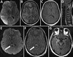 Thumbnail of Magnetic resonance imaging findings for 3 patients with coronavirus disease who had neurologic complications, Atlanta, Georgia, USA, 2020. A–D) Patient 1 had right cerebral hemispheric restricted diffusion (diffusion weighted imaging in panel A) and cerebral edema (fluid-attenuated inversion recovery [FLAIR] in panel B) affecting gray matter and deep gray nuclei, without enhancement (panel C), and spinal edema (panel D). E, F) Patient 2 had a splenium lesion (diffusion weighted imag