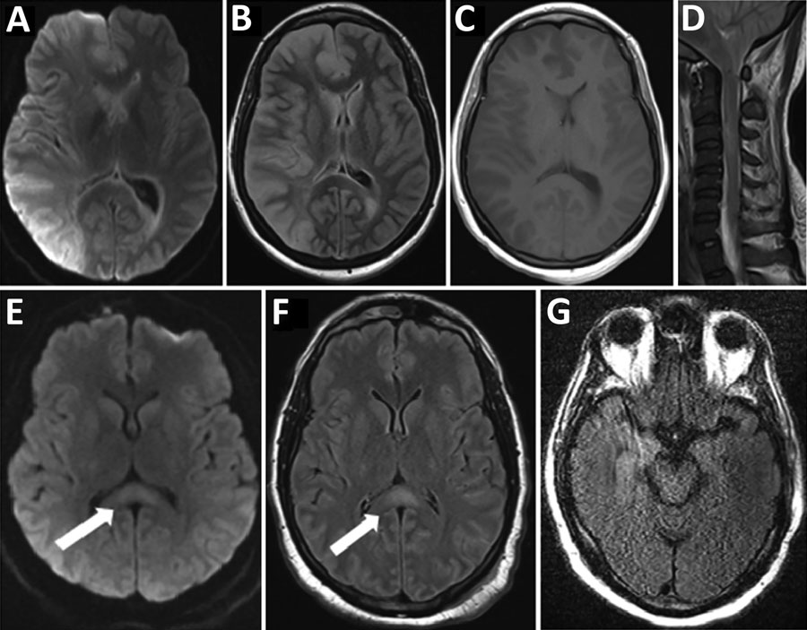 Magnetic resonance imaging findings for 3 patients with coronavirus disease who had neurologic complications, Atlanta, Georgia, USA, 2020. A–D) Patient 1 had right cerebral hemispheric restricted diffusion (diffusion weighted imaging in panel A) and cerebral edema (fluid-attenuated inversion recovery [FLAIR] in panel B) affecting gray matter and deep gray nuclei, without enhancement (panel C), and spinal edema (panel D). E, F) Patient 2 had a splenium lesion (diffusion weighted imaging in panel 