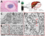 Findings from a 68-year-old woman with scrub typhus, South Korea, 2019. A) Eschar in the right inguinal area. B) Human bile collected through percutaneous transhepatic gallbladder drainage in the gallbladder of a patient affected with scrub typhus. C–F) Transmission electron microscopy images of Orientia tsutsugamushi in the bile. Bacteria (black asterisks); outer membrane (OM) and plasma membrane (PM) (red arrows); multilamellar body (black arrowheads); Scale bars indicate 1 μm.