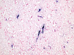 Brain specimen from Mexican wolf pup infected with eastern equine encephalitis virus (EEEV) at Binder Park Zoo, Michigan, USA. Blue stain shows EEEV nucleic acid in the perikaryon and dendrites of necrotic and intact neurons. Nuclear fast red counterstain shows nitro blue tetrazolium/5-Bromo-4-chloro-3-indolyl phosphate (NBT/BCIP) chromogen.