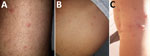 Aspects of lesions caused by larvae of Anthrenus sp. carpet beetles on 3 members of the same family, France. A) Thigh of a 33-year-old man; B) abdomen of a 5-year-old boy; C) leg of an 8-year-old girl (who scratched lesions).