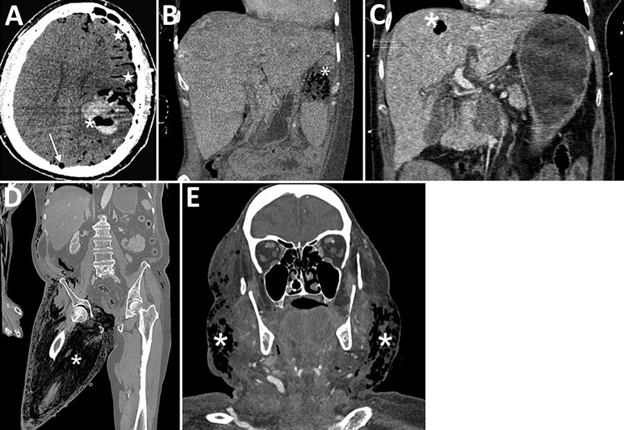 Several examples of hematogenous spreads or myonecrosis related to Clostridioides bacteremia in patients in France. All these localizations were associated with air formation. A) Brain abscess associated with pneumocephalus and gas embolism in the superior sagittal sinus. B) Splenic abscess (asterisk) with gas formation. C) Hepatic abscess with gas formation. D) Massive pelvic gangrene identified as the origin of the bacteremia in a patient. E) Cervical cellulitis, identified as the origin of the bacteremia in a patient.