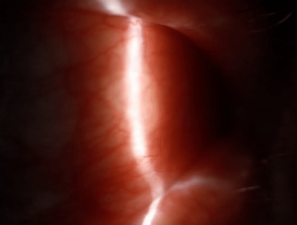 Slit lamp video of live, coiled male filarial nematode, Breinlia (Johnstonema) annulipapillata, from the subconjunctiva of a human patient with ocular filariasis, Brisbane, Queensland, Australia, 2019.